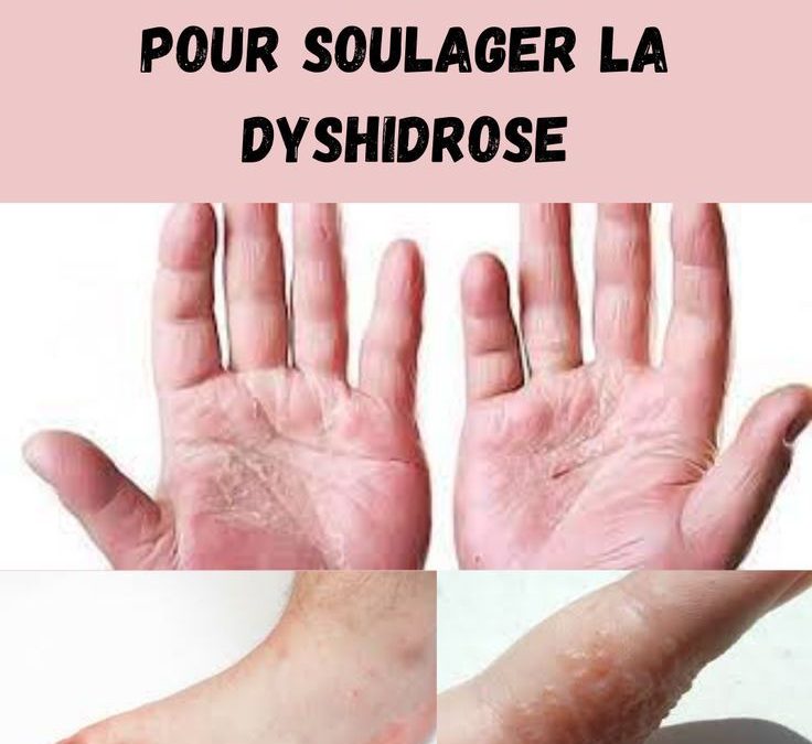 Dyshidrose des mains : méthodes efficaces pour apaiser et traiter